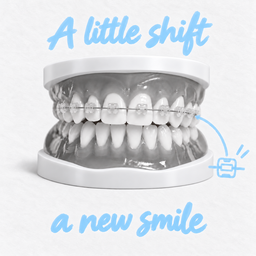 Damon Braces