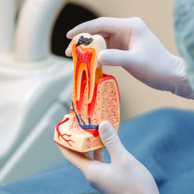 Root Canal